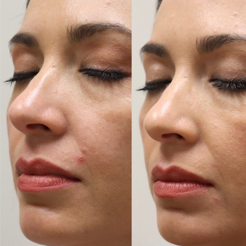 Cheek Filler case #5248