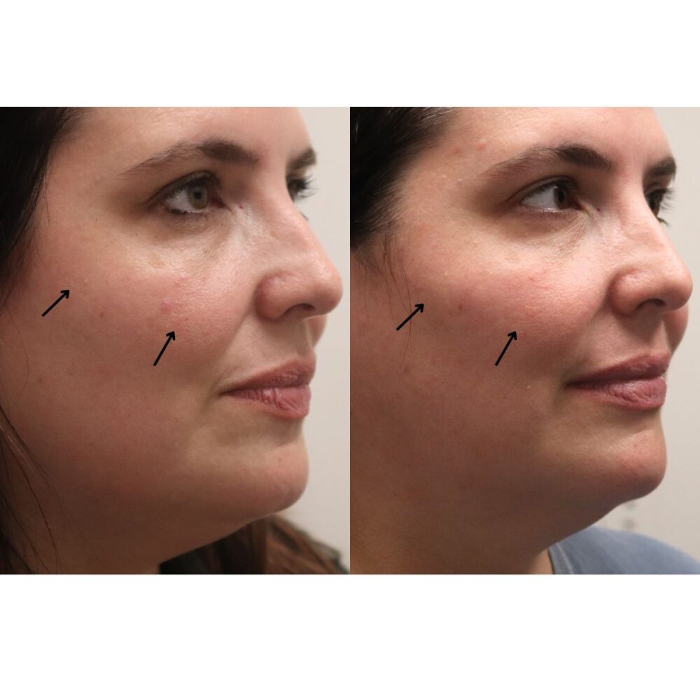 Cheek Filler case #5250