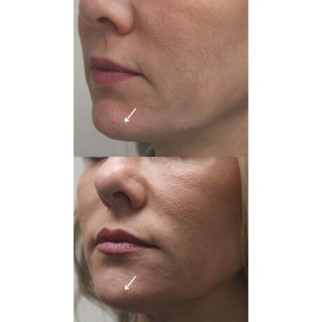 Chin Filler case #5290