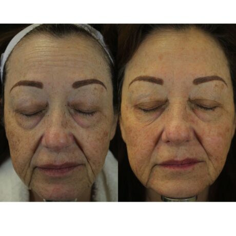 DermaFrac case #4909