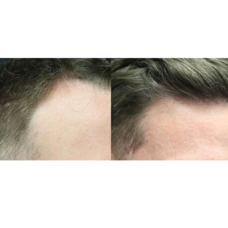 Hair Transplant case #5173