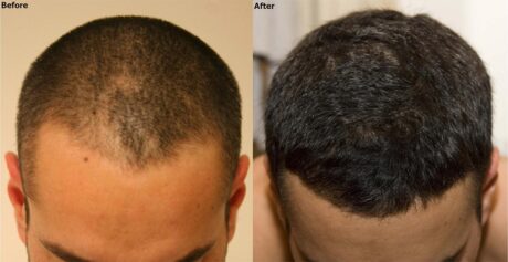 Hair Transplant case #5183