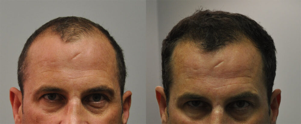 Hair Transplant case #5185