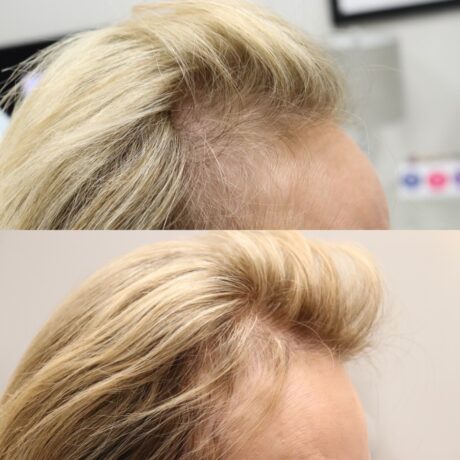 PRP for Hair Restoration case #5038