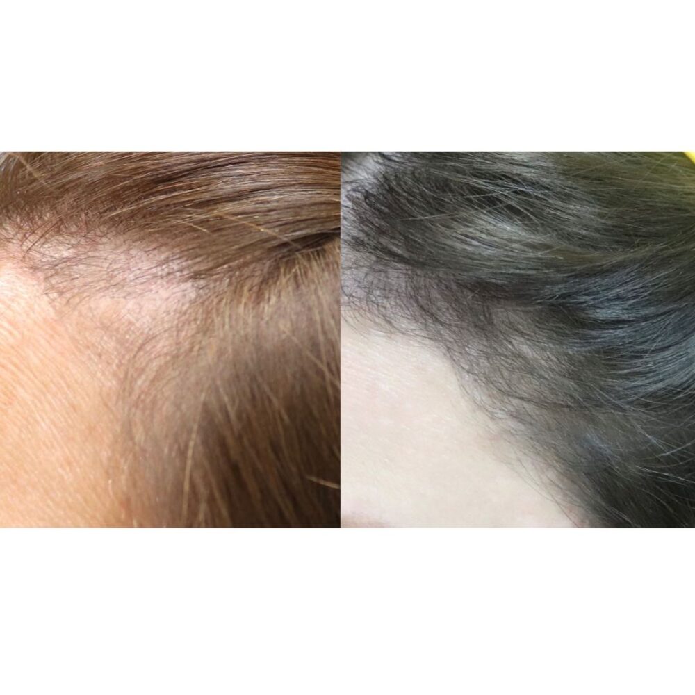 Hair Transplant case #5177