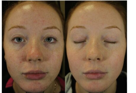 IPL Photofacial case #5159