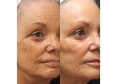 Cheek Filler case #5254