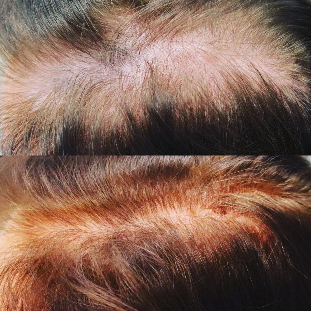 PRP for Hair Restoration case #5036