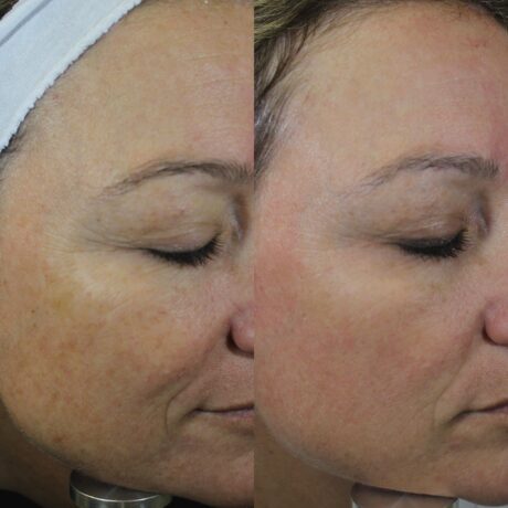 IPL Photofacial case #5157