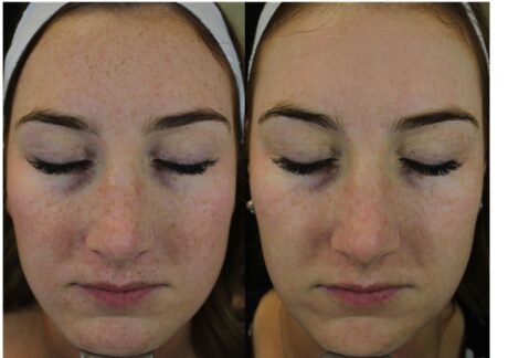 IPL Photofacial case #5155