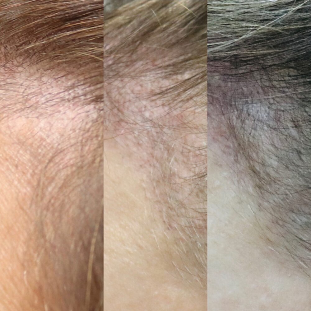 Hair Transplant case #5175