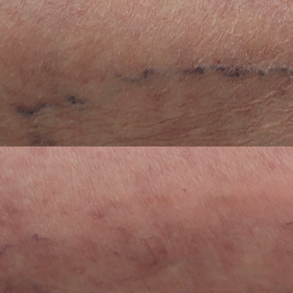 Sclerotherapy case #4996