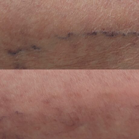 Sclerotherapy case #4996