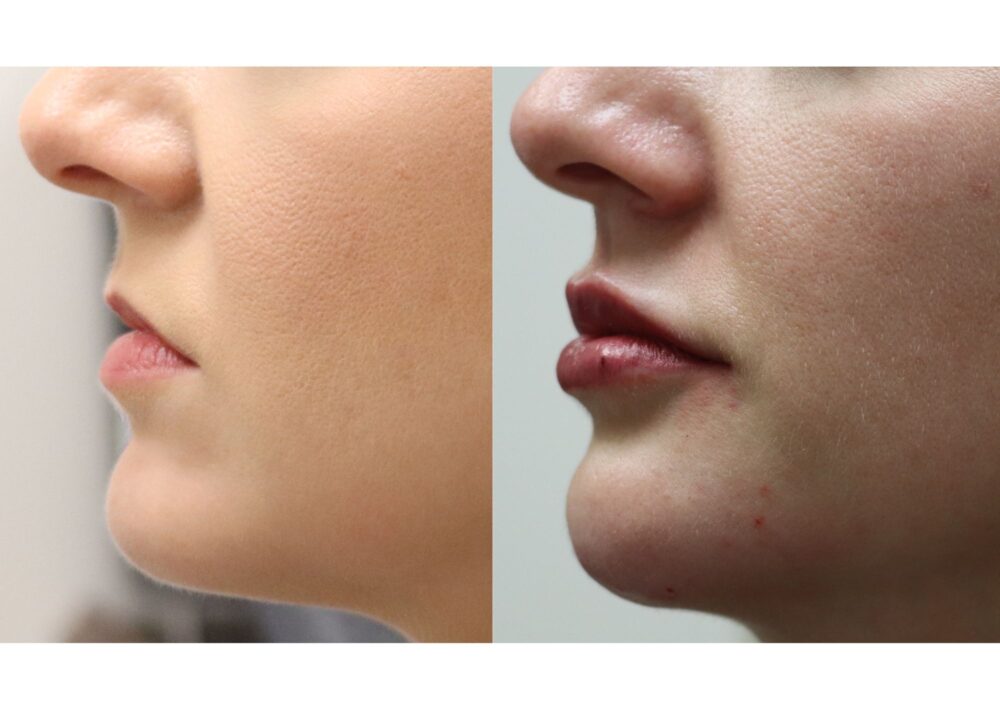 Chin Filler case #5287