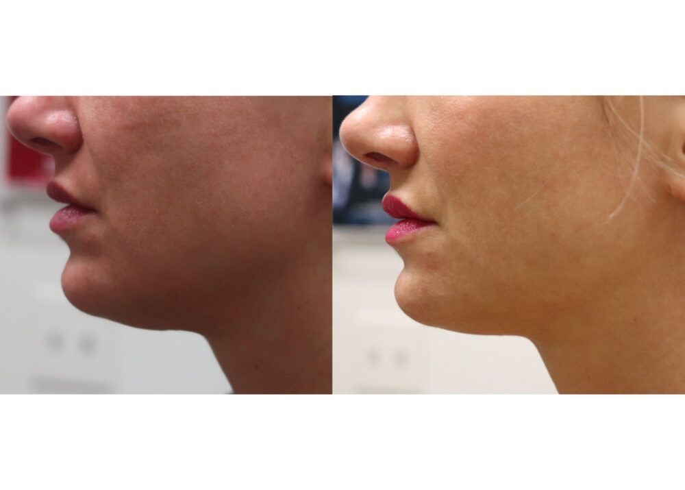 Mesotherapy case #5108