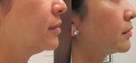 Mesotherapy case #5104