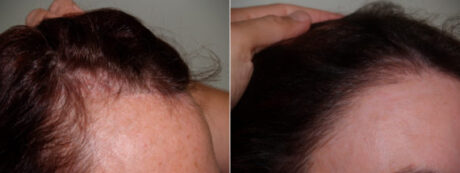 Hair Transplant case #5181