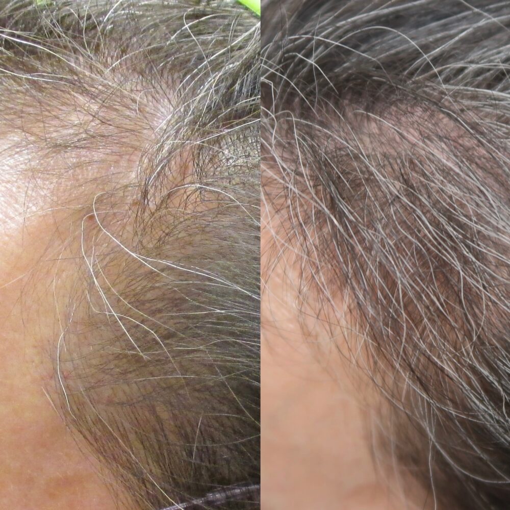 PRP for Hair Restoration case #5034