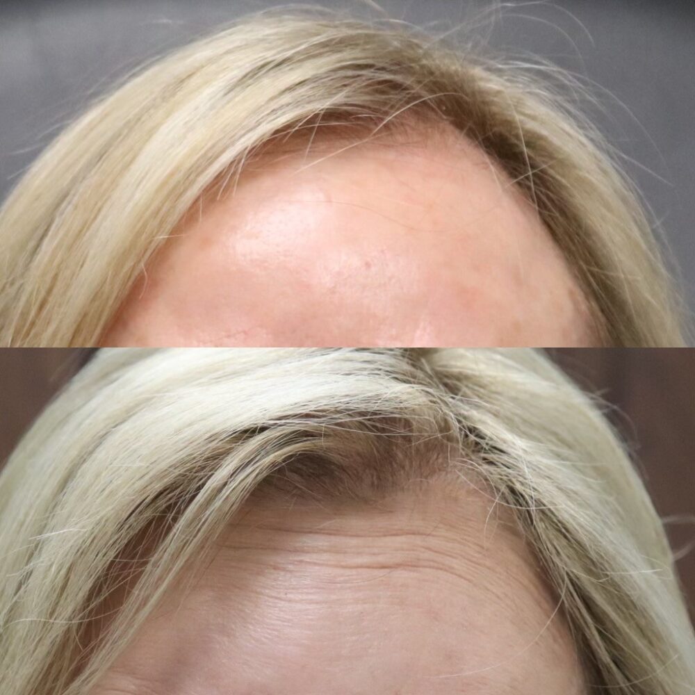 PRP for Hair Restoration case #5032