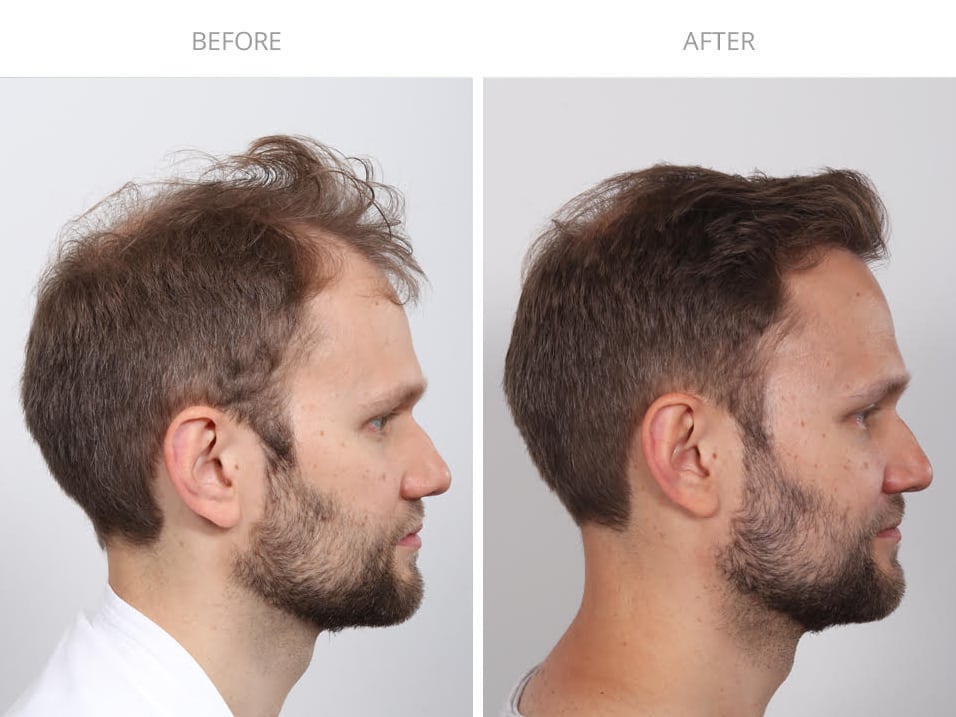 Hair Transplant case #5189