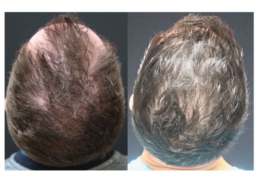 Hair Transplant case #5187