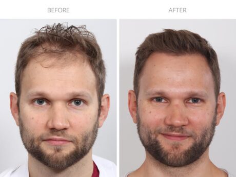 Hair Transplant case #5189