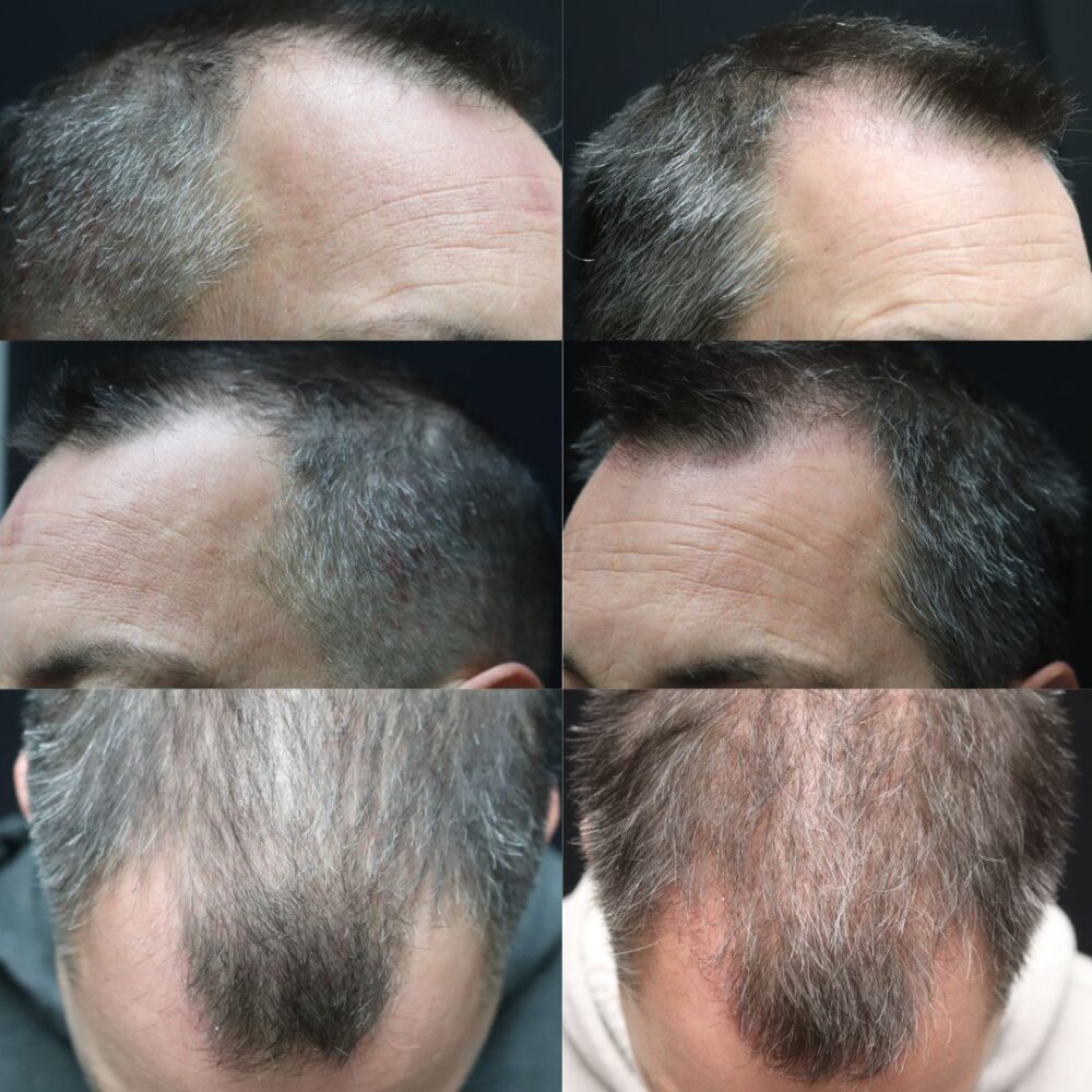 Hair Transplant case #5192