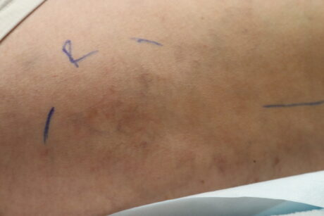 Sclerotherapy case #4994