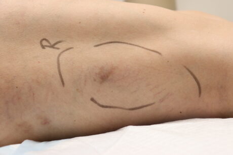 Sclerotherapy case #4992