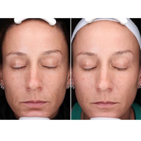 IPL Photofacial case #5153