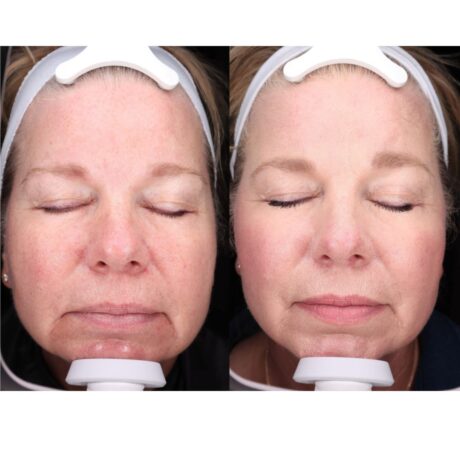 IPL Photofacial case #5151