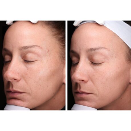 IPL Photofacial case #5149