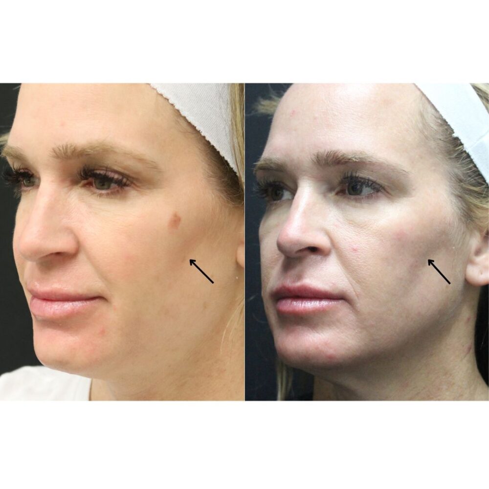 Cheek Filler case #5263