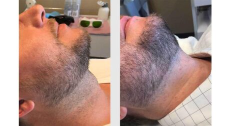 Laser Hair Removal case #5130