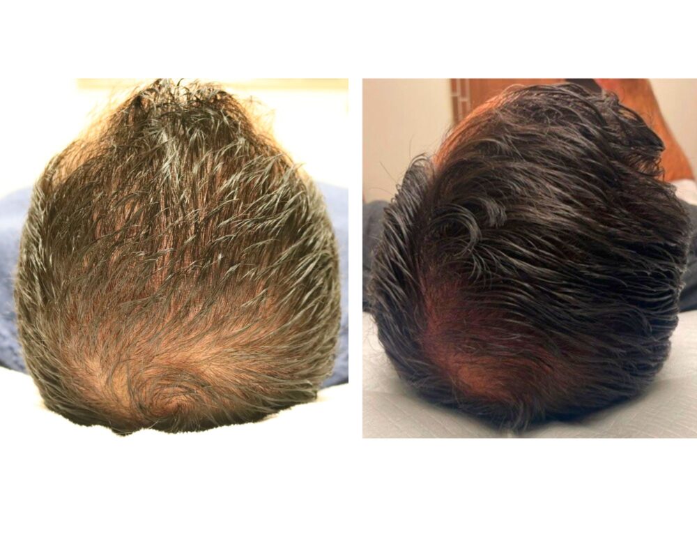 PRP for Hair Restoration case #5017