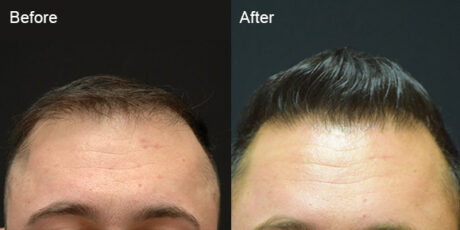 Hair Transplant case #5198