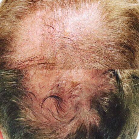 PRP for Hair Restoration case #5028