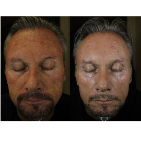 IPL Photofacial case #5147