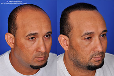 Hair Transplant case #5200