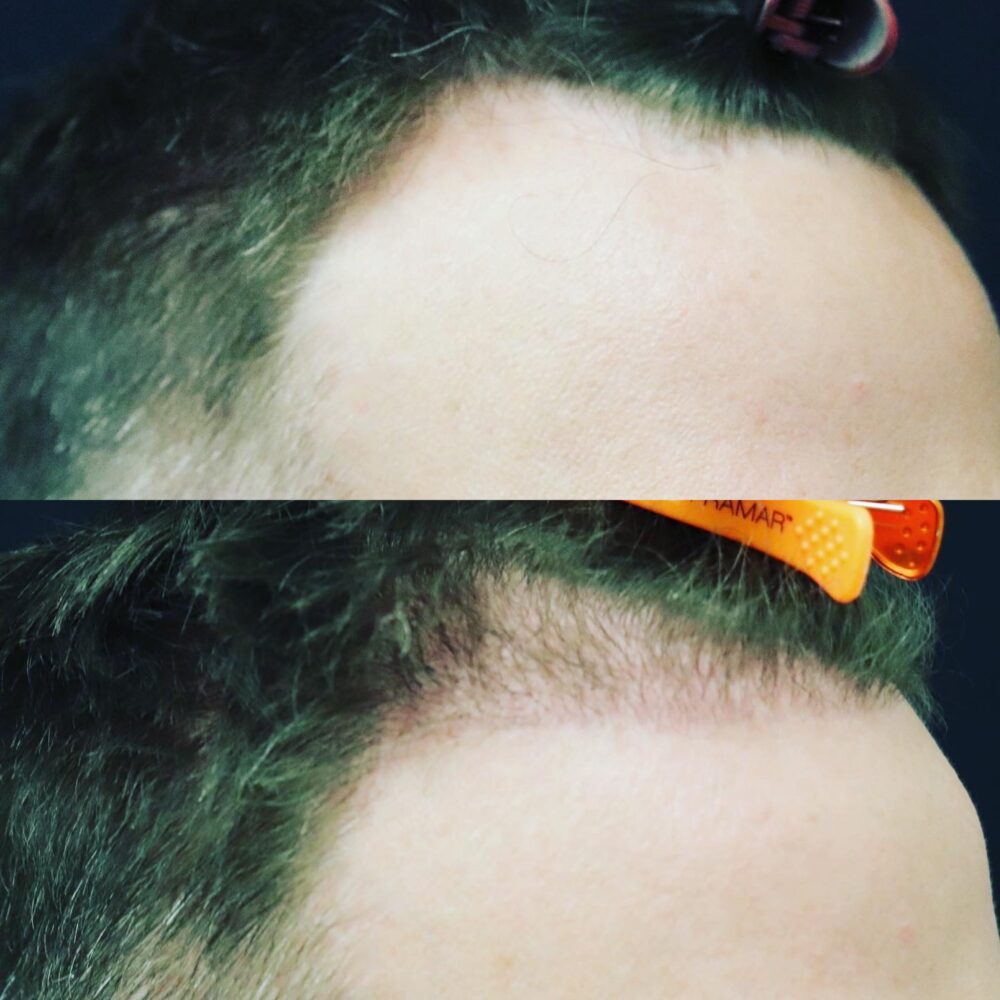 Hair Transplant case #5202