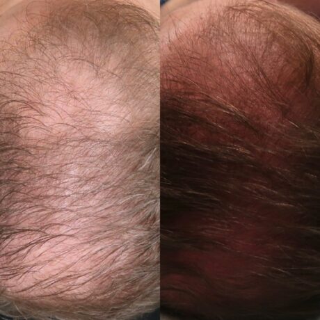 PRP for Hair Restoration case #5030