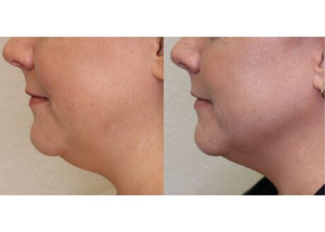 Mesotherapy case #5100