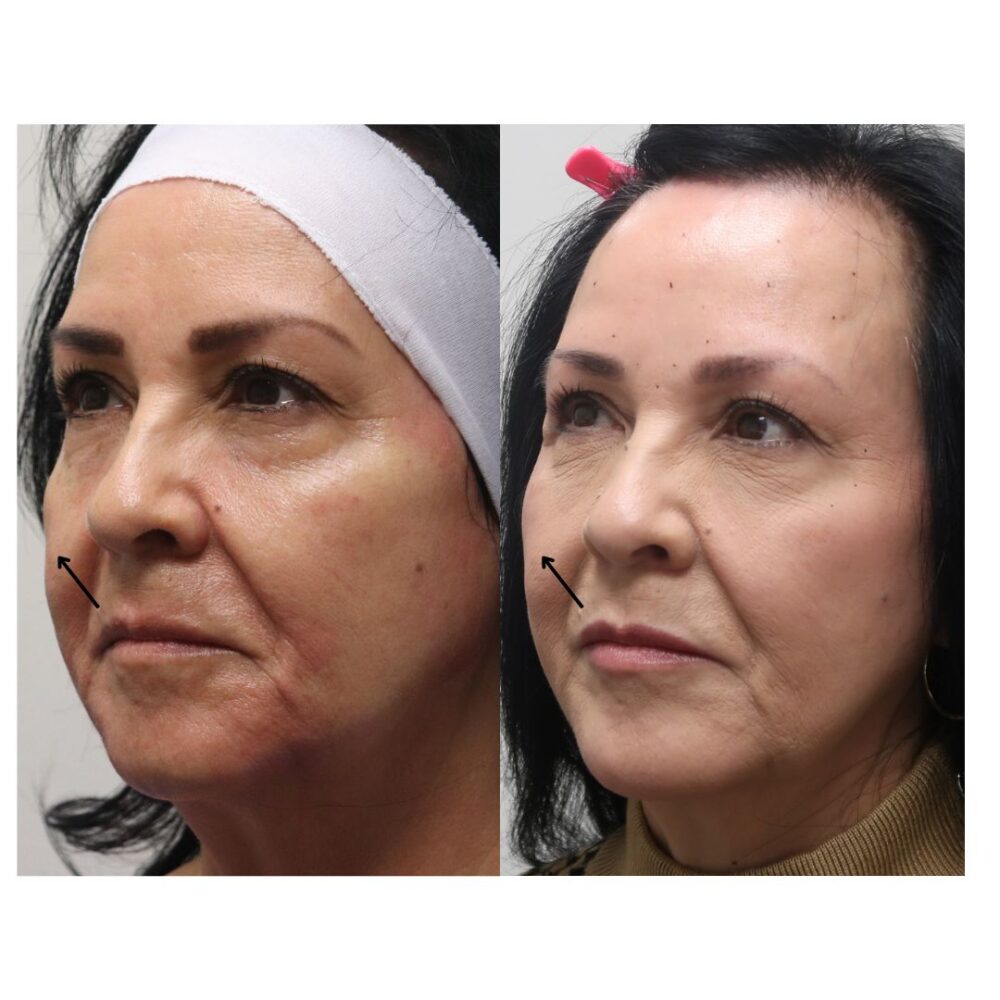 Cheek Filler case #5265