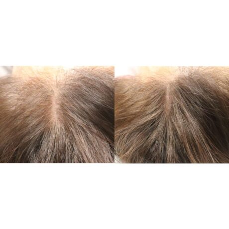 PRP for Hair Restoration case #5011