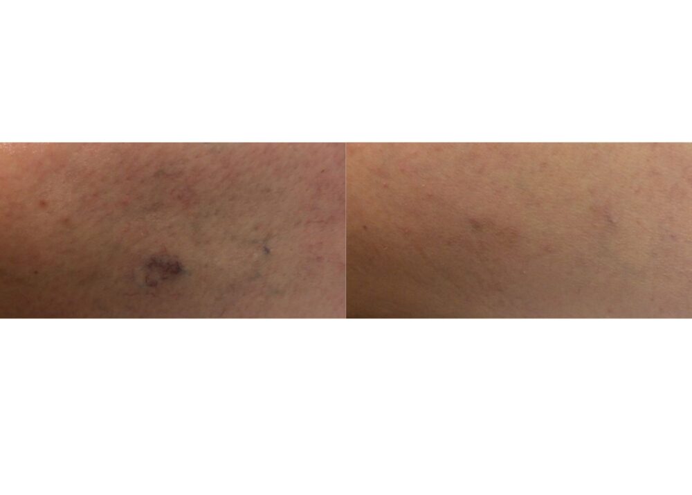 Sclerotherapy case #4990