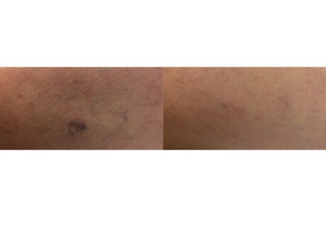 Sclerotherapy case #4990