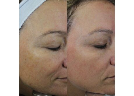 IPL Photofacial case #5140