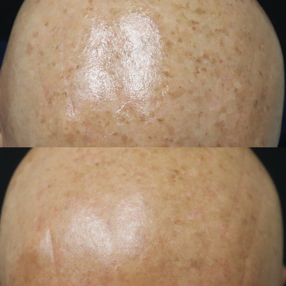 IPL Photofacial case #5138