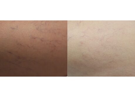 Sclerotherapy case #4988