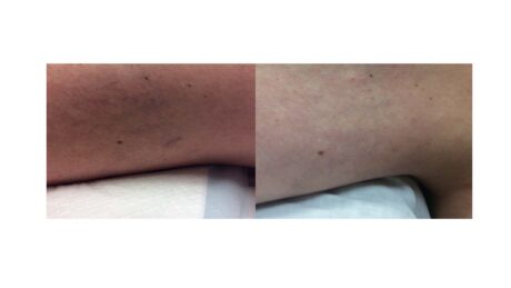 Sclerotherapy case #5005